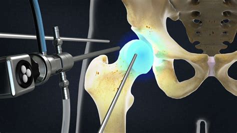 Hip Arthroscopy California Orthopaedic Specialists