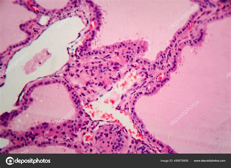 Endemic Goiter Light Micrograph Abnormal Enlargement Thyroid Gland Due