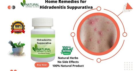 Hidradenitis Suppurativa Treatment Home Remedies Archives - Natural ...