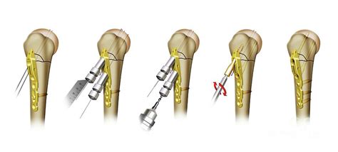 Shoulder Fracture Surgery Photograph by Maurizio De Angelis/science Photo Library - Fine Art America