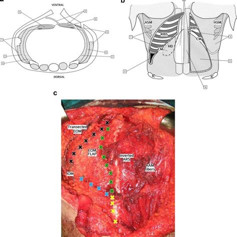 Classification Of Postoperative Seroma After Ventral Hernia Repair As