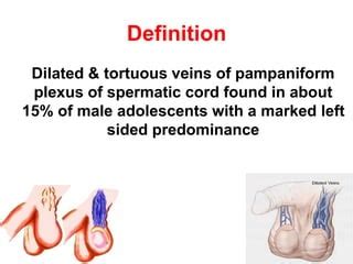Varicocele.ppt 