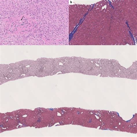 A Paraportal Shunt Vessel Arrow In Idiopathic Non Cirrhotic Portal