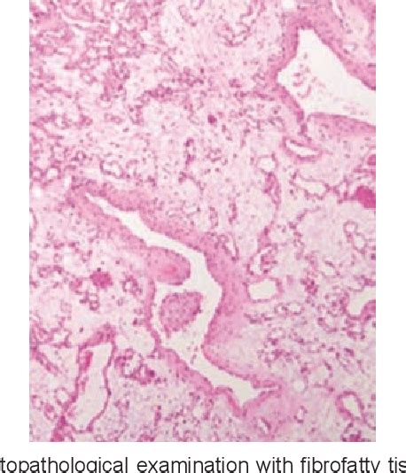 Figure From A Rare Case Of Dumbbell Shaped Spinal Epidural Capillary