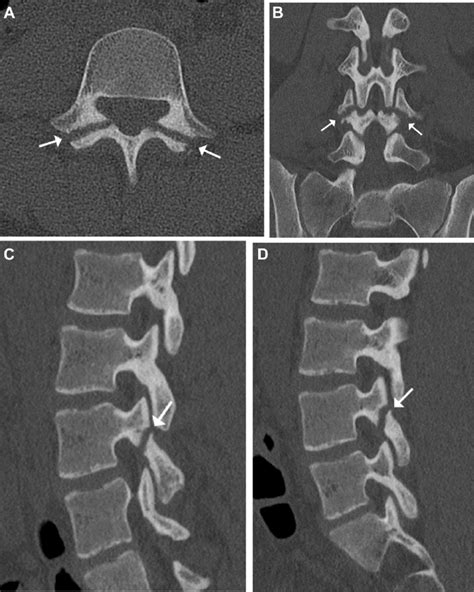 Bilateral L4 Pars Defect Arrows On Computed Tomography Ct A Download Scientific Diagram