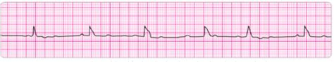 Acls Pretest Flashcards Quizlet