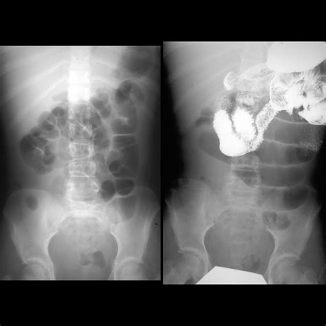 Pediatric Small Bowel Obstruction | Pediatric Radiology Reference