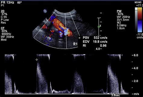 Color Pulsed Wave Doppler Of The Proximal Right Subclavian Artery