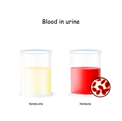 Hematuria (Blood in Urine) - Feifer Urology