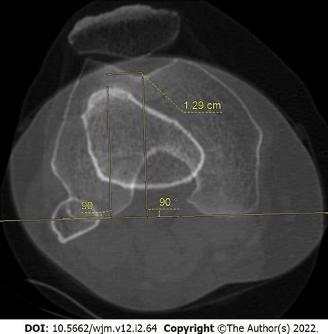 Tibial Tuberosity Trochlear Groove Distance Measurement Superimposed