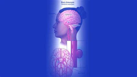 Saccular Aneurysms: Causes, Symptoms, Diagnosis, and Treatment - MDMEDICINE