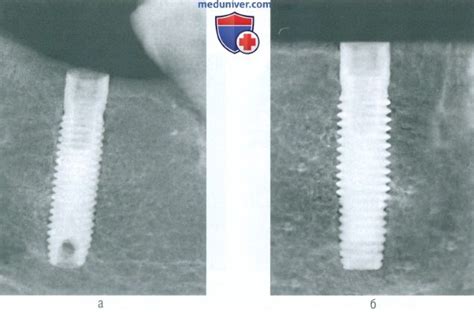 Цифровая микрофокусная внутриротовая рентгенография при зубной ...