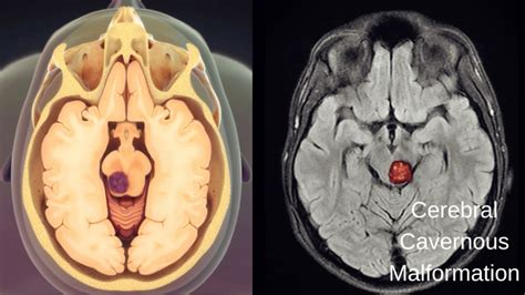 Periventricular Leukomalacia Life Expectancy | Birth Injury Center