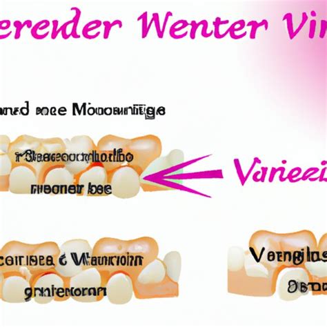 How Does Veneers Work Exploring The Process And Benefits The