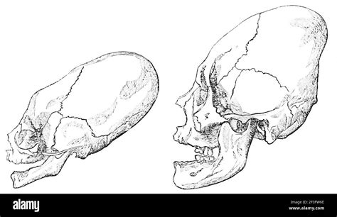 Deformed skulls hi-res stock photography and images - Alamy