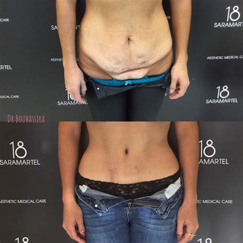 Abdominoplastie Dr Bouhassira Sp Cialiste Cannes Antibes De La