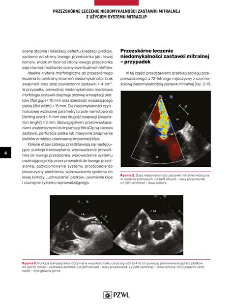 Przezsk Rna Implantacja Zastawki Aortalnej Tavi Dla Kardiolog W