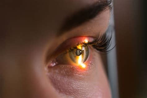 El Glaucoma La Enfermedad Silenciosa Anfer Optica