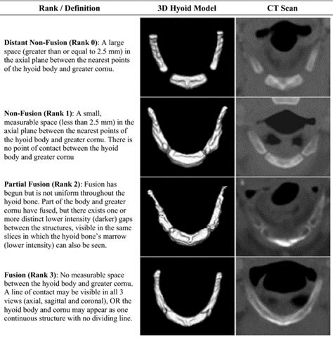 Hyoid Bone Fusion And Bone Density Across The Lifespan Prediction Of Age And Sex Springerlink