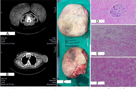 Figure 2 From Pseudoangiomatous Stromal Hyperplasia Of The Breast