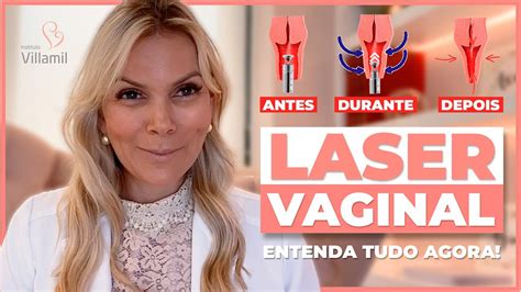 Laser Vaginal Saiba Tudo Sobre O Rejuvenescimento íntimo Dra