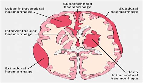 Intracranial Hemorrhage | 10 Details That You Must Know About