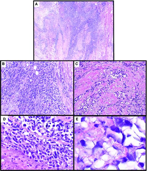 Histopathologic Features Of The Urinary Bladder Tumor A Low