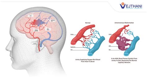 Brain AVM – Rare but a Fatal Condition to be Aware of