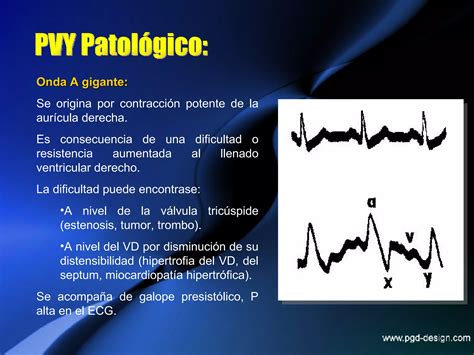 Pulso Venoso Yugular PPT