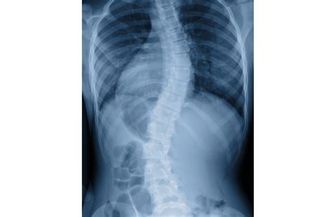 How Physical Therapy Can Help Scoliosis Balance Within Integrative