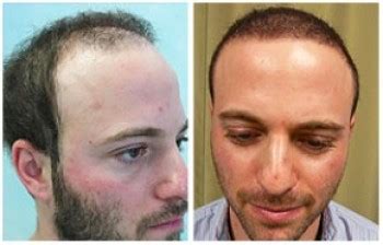 Body Hair Transplant Results - BHT - DermHair Clinic L.A. 1-310-318-1500