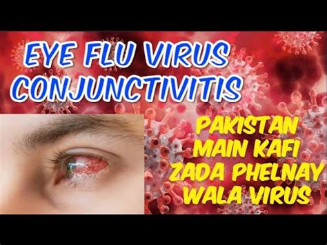 Eye Conjunctivitis And Treatment Pakistan Main Kafi Zada Phelnay Wala