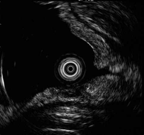 Endoscopic Ultrasonography Eus Showed A Low Echoic Mass In The Second Download Scientific