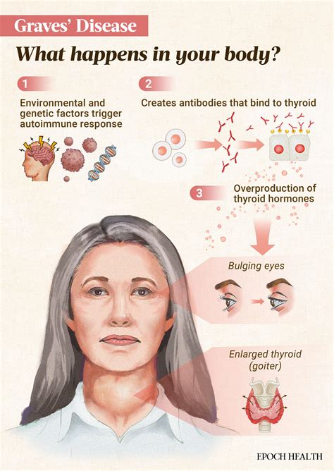 Graves’ Disease: Symptoms, Causes, Treatments, and Natural Approaches