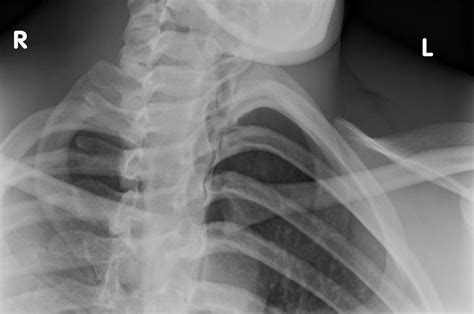 Management Of Traumatic Sternoclavicular Joint Injuries Post