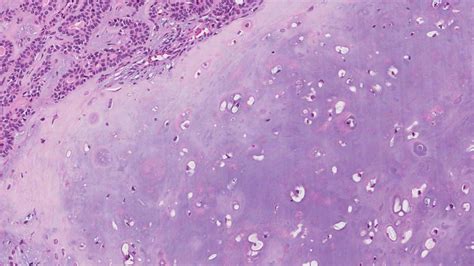 Pleomorphic adenoma | Ottawa Atlas of Pathology