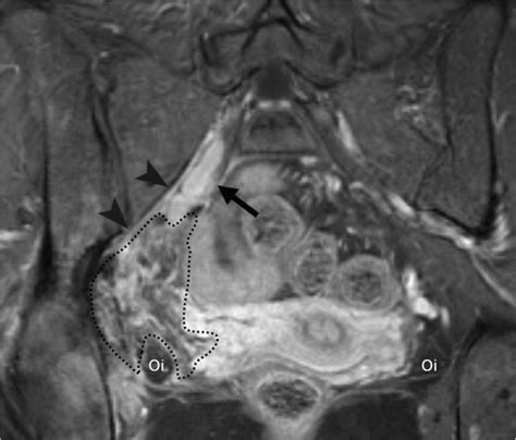 Coronal T1 Weighted MRI With Intravenous Gadolinium Contrast Showing