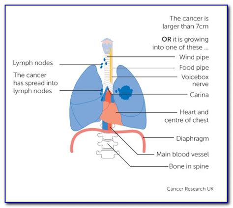 Lung Cancer Labeled Diagram | prosecution2012