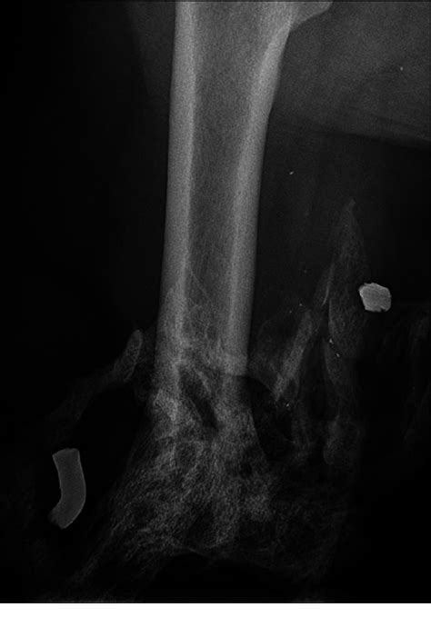 Radiograph Showing Heterotopic Ossification Ho In Transfemoral Download Scientific Diagram