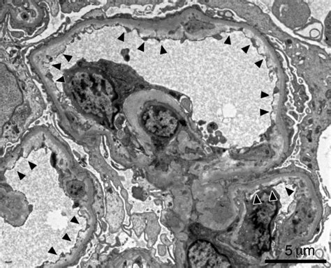 Electron Microscopy Findings Of Renal Biopsy Subendothelial Widening