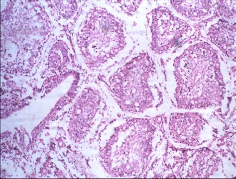 Bursa of Fabricius; lymphoid atrophy and vacuolation of follicular... | Download Scientific Diagram