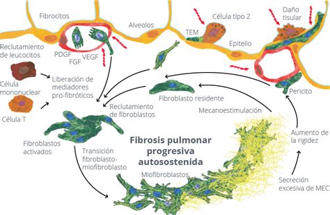 Af Avances En Fibrosis Pulmonar El Tratamiento Antifibr Tico Para