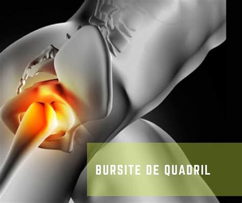 Bursite De Quadril O Que Cl Nica De Fisioterapia E Pilates Itaim