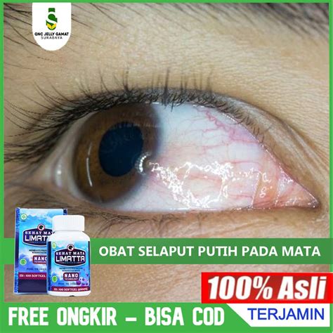 Jual Obat Herbal Selaput Putih Pada Mata Lamad Mata Pterygium Sehat