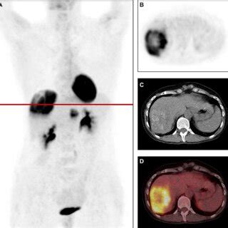 A Maximum Intensity Projection B D F Fdg Pet Ct And Fused F Fdg