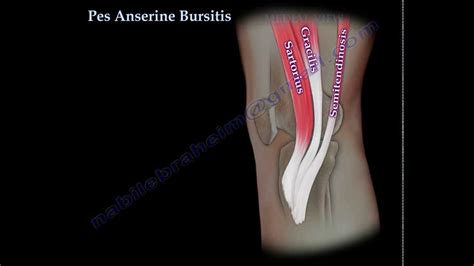 Pes Anserine Bursitis Knee Pain Everything You Need To Know Dr