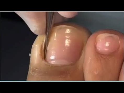 How To Cut Thick Toenails Ingrown Nail Tutorial Cleaning Satisfying