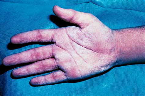 Aquagenic Palmoplantar Keratoderma Journal Of The American Academy Of