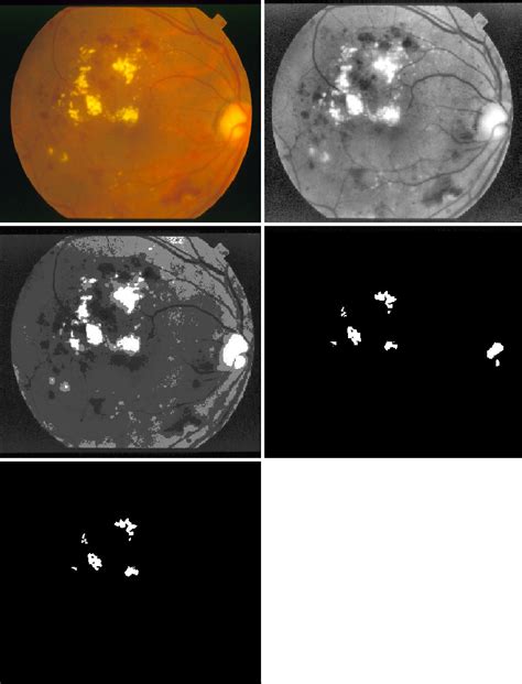 Diabetic Retinopathy Detection In Digital Fundus Images Retina Classifier