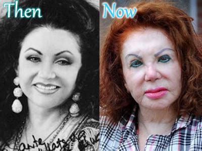 Jackie Stallone Plastic Surgery: Before After Bad Facelift, Fillers ...